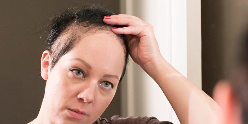 Trikotillomani (Saç Yolma Hastalığı) Trikotillomani (Saç Yolma Hastalığı)